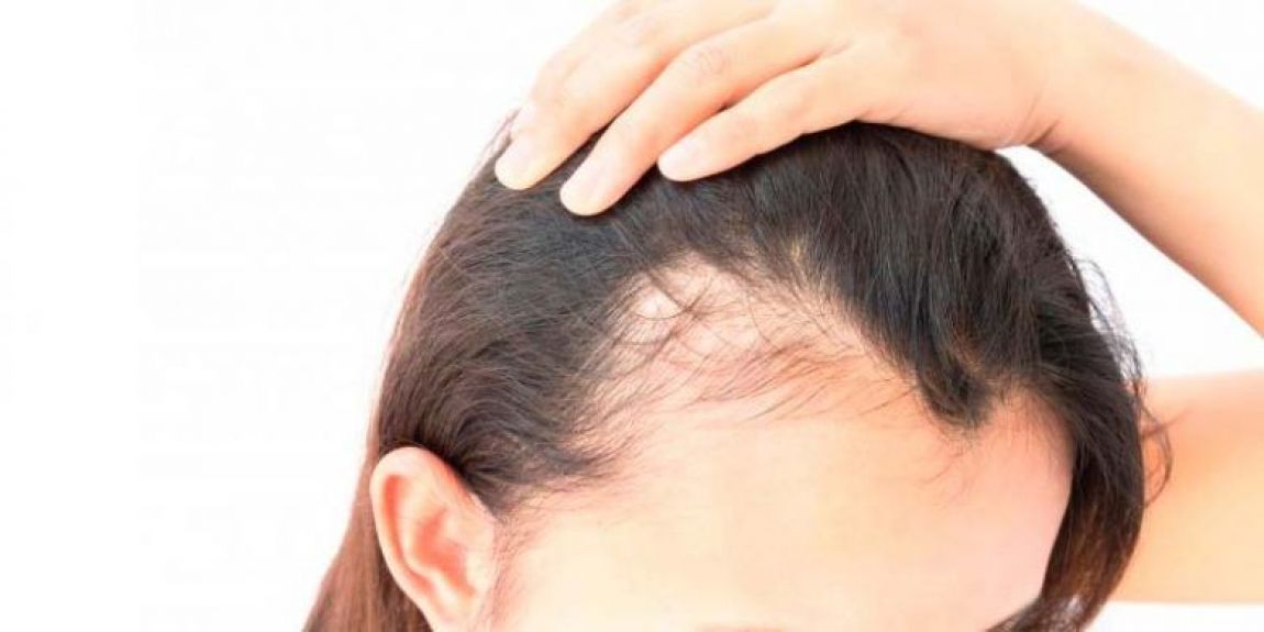 Tratamiento de Alopecia Femenina